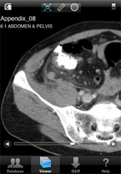 Image:  The appendix as viewed on an iPhone 3G (Photo courtesy of Dr. A Choudhri - RSNA org.).